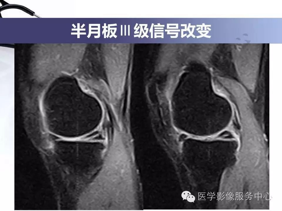 半月板病变的磁共振诊断值得一看