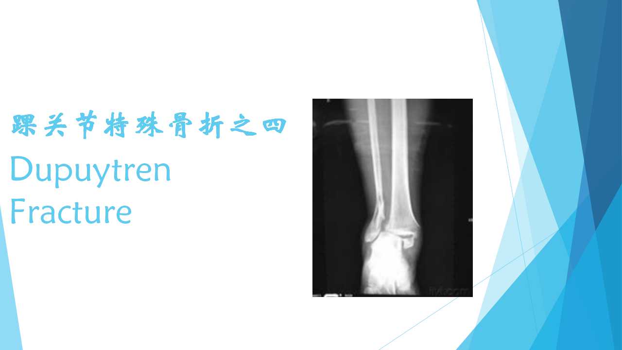 特殊类型的踝关节骨折四dupuytrenfracture