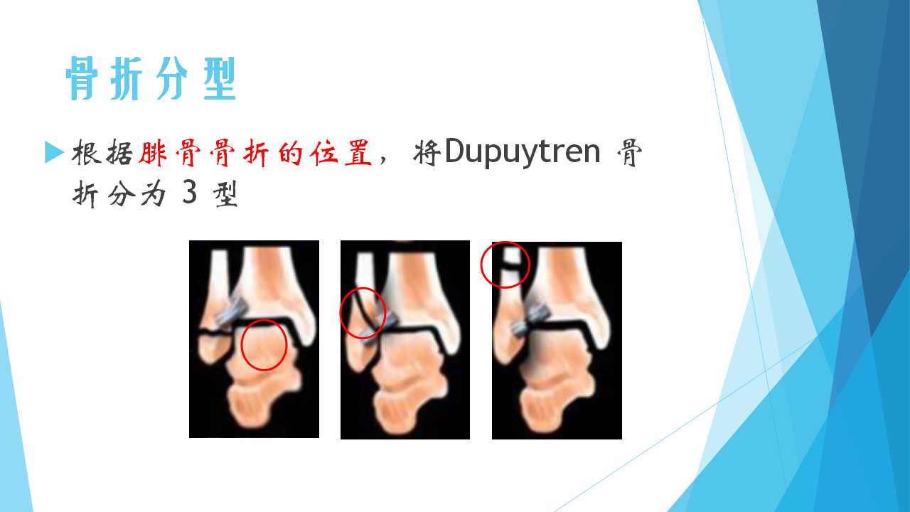 特殊类型的踝关节骨折四dupuytrenfracture