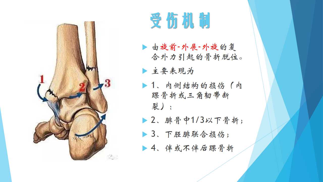 特殊类型的踝关节骨折四dupuytrenfracture