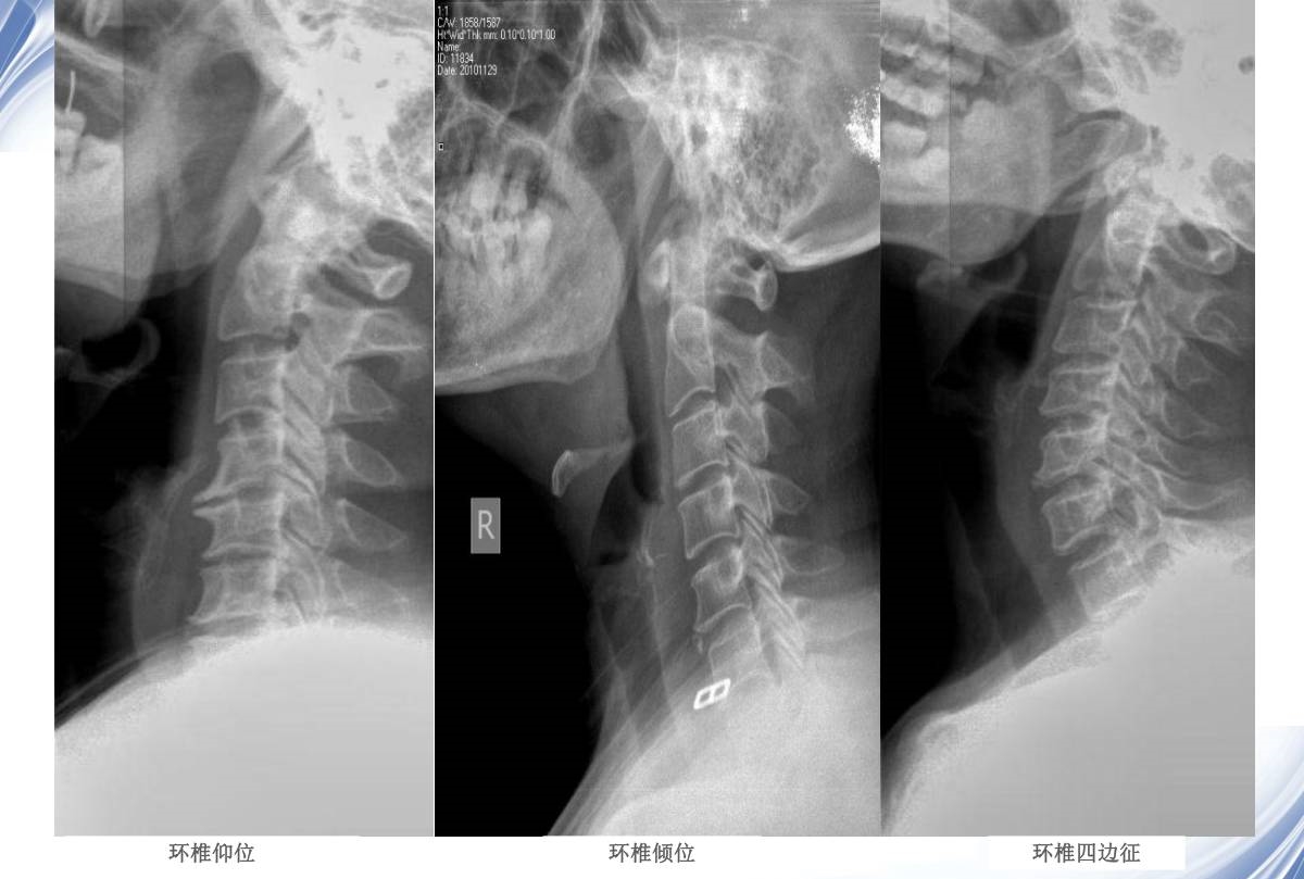 颈椎x线诊断的内容及其解读