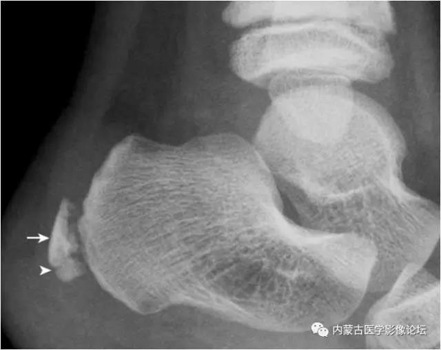 haglund外生骨疣与不典型骨刺:跟骨后上缘骨刺样突起(箭,属正常变异