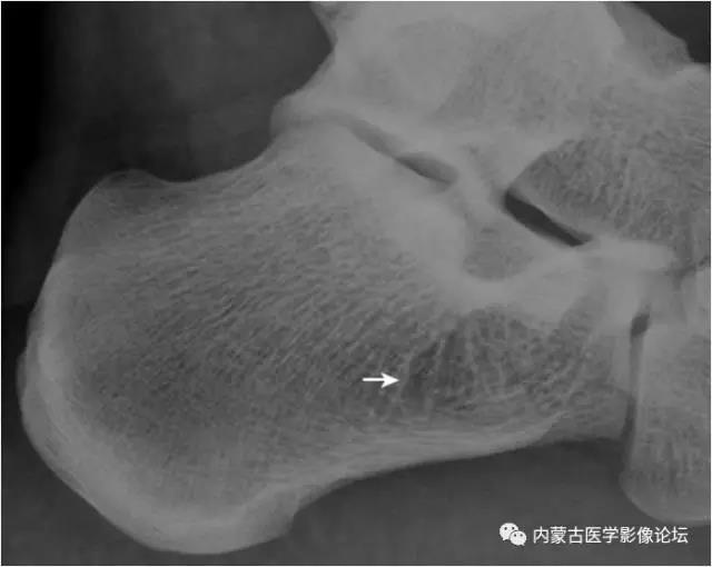 haglund外生骨疣与不典型骨刺:跟