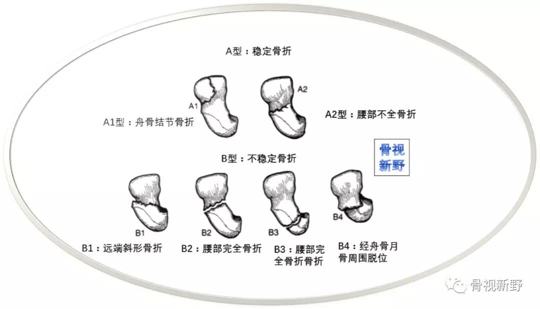 舟状骨急性骨折的分型及其临床意义