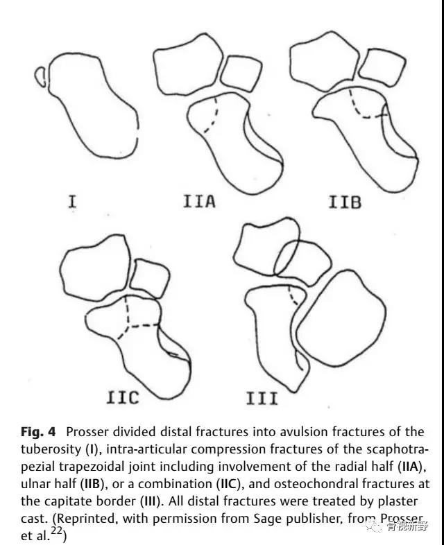 舟状骨急性骨折的分型及其临床意义