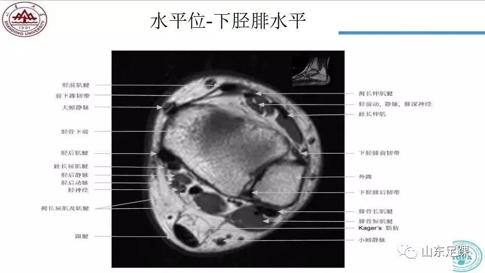 踝关节mri的断层解剖值得收藏备用