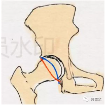 髋关节各种测量方法汇总,值得收藏备用!