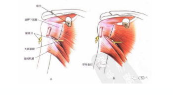 肩胛骨骨折的解剖及手术入路详解值得一看