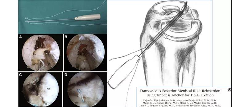 半月板缝合新方法经骨道缝合技巧及要点详解
