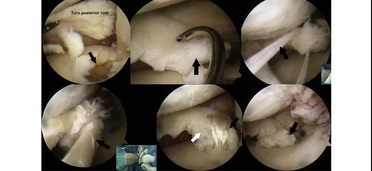 半月板缝合新方法经骨道缝合技巧及要点详解
