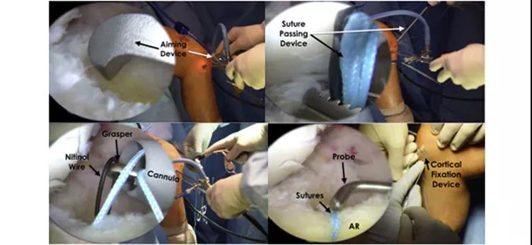 半月板缝合新方法经骨道缝合技巧及要点详解