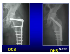 置换)3,外固定系统:外固定支架2,髓内系统:pfn,r钉等1,钉板系统:dhs