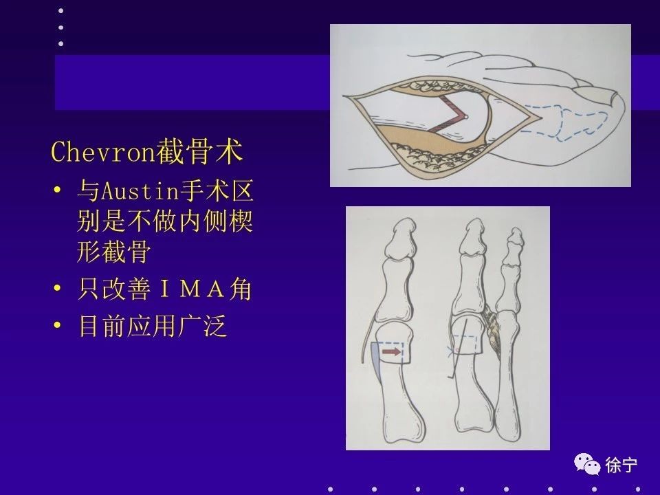 拇外翻的手术治疗技巧全在这篇文章里