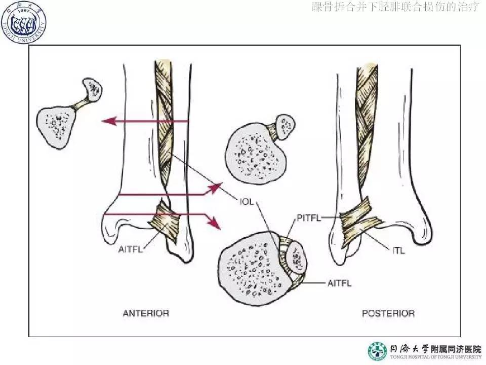 俞光榮教授帶你瞭解踝骨折合併下脛腓聯合損傷的治療