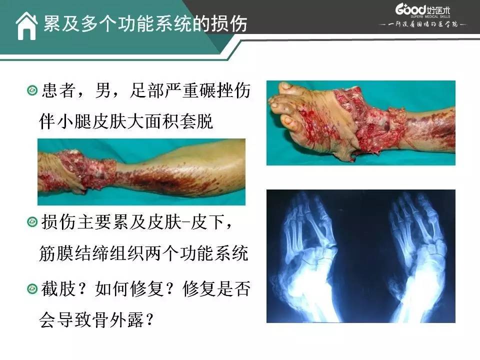 柴益民软组织损伤的诊断评估分型和处理原则上