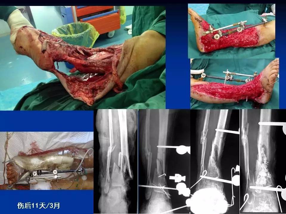 小腿嚴重創傷&外固定後——創面&骨的處理經驗教訓