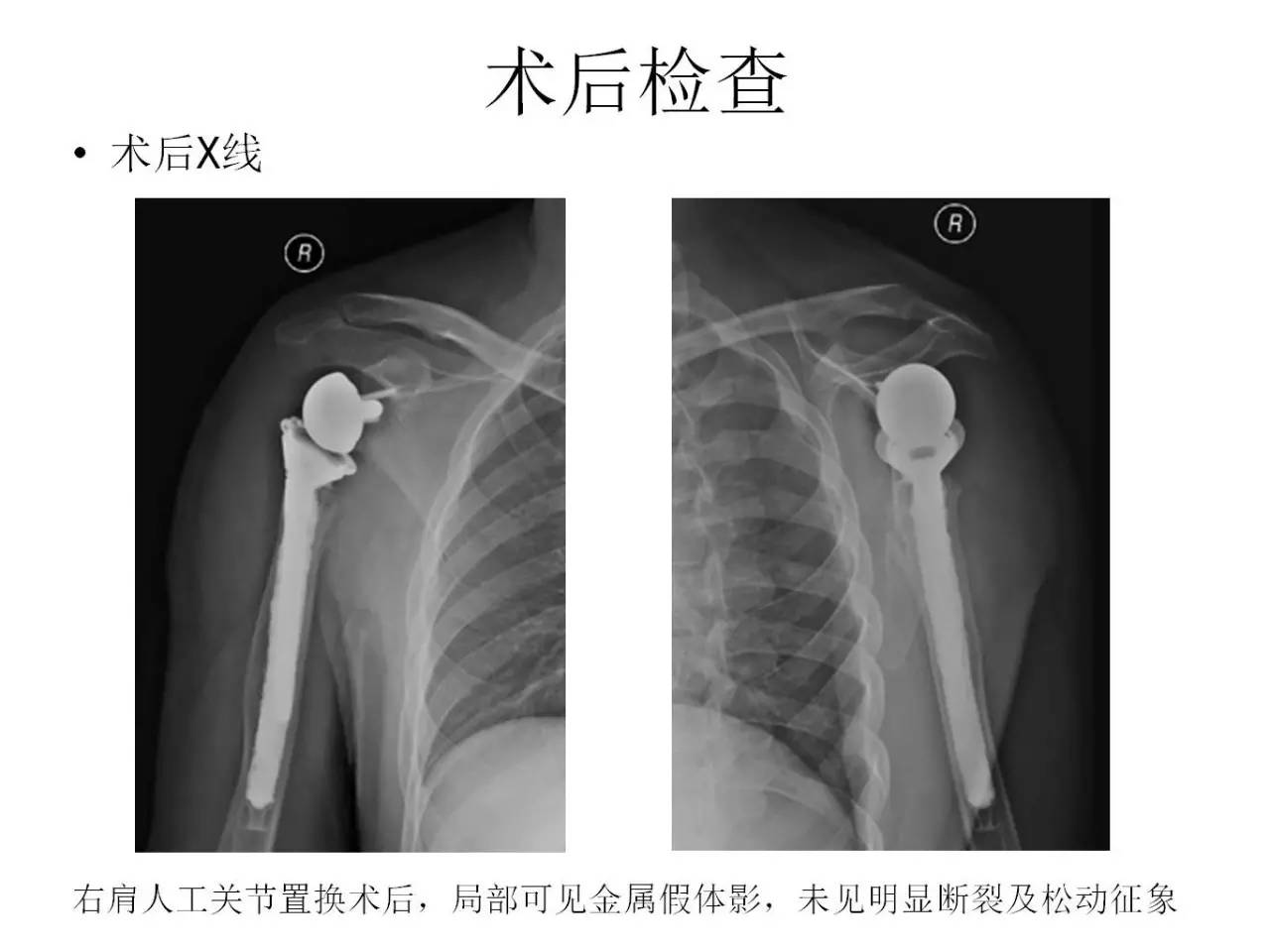 3D打印个性化骨干假体置换实现保留骨骺的青少年骨肉瘤的保肢治疗术_中国3D打印网
