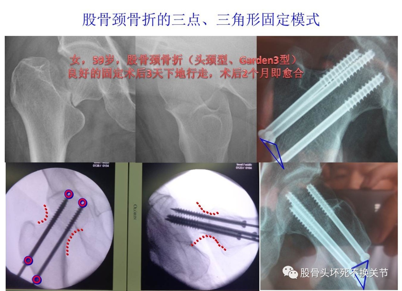 股骨頸骨折註定要人工關節置換?