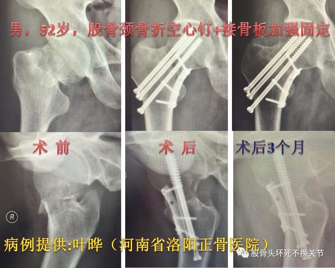 股骨粗隆间粉碎性骨折了，不用怕，及时治疗很关键|内分泌科|粉碎性|麻醉科|股骨|骨折|骨科|关节|-健康界