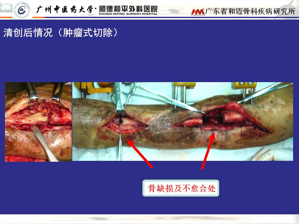 顯微技術治療骨髓炎骨缺損