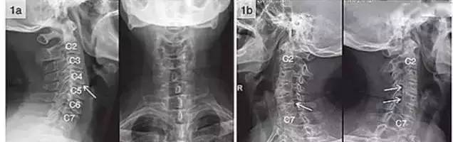 颈椎x线平片读片诊断口诀