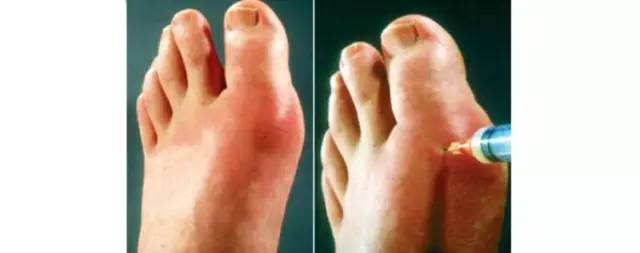 烦人的膝关节痛风