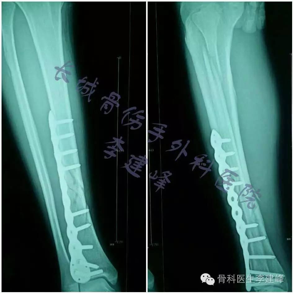 胫腓骨骨折的治疗方法 好医术早读文章 好医术 赋能医生守护生命