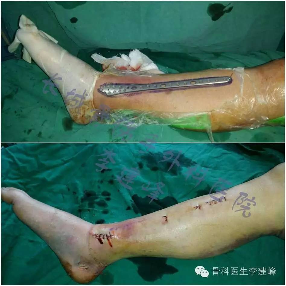 胫腓骨骨折的治疗方法