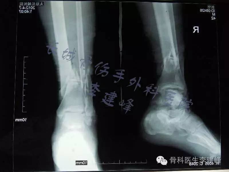 胫腓骨骨折的治疗方法 好医术早读文章 好医术 赋能医生守护生命