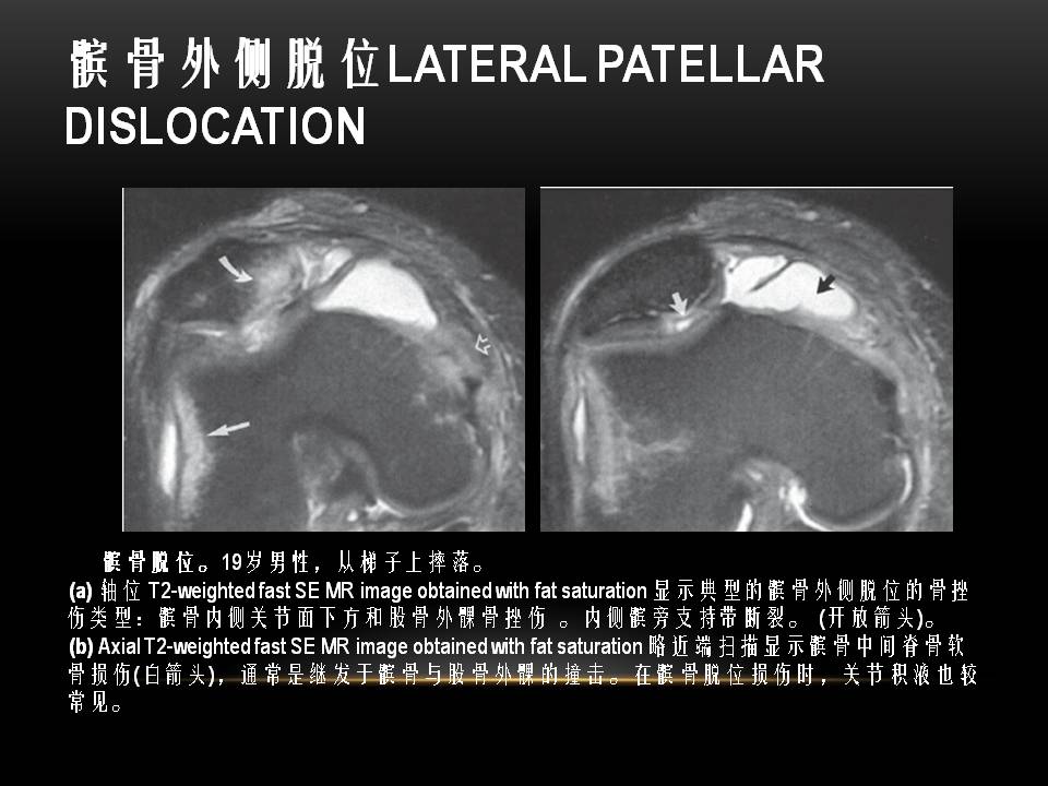 膝关节骨挫伤的分类及特点