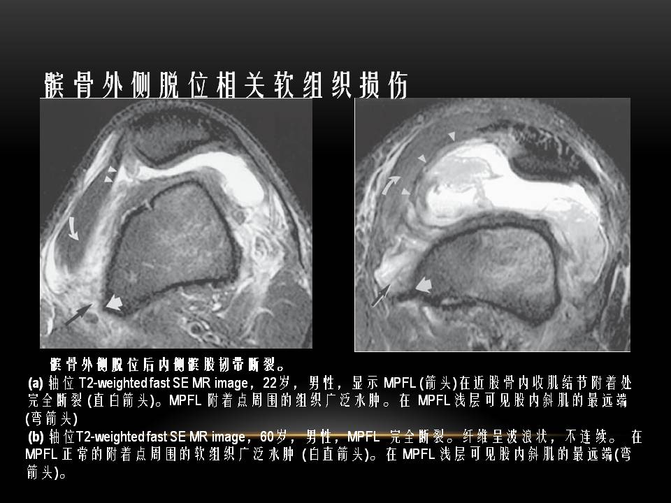 膝关节骨挫伤的分类及特点