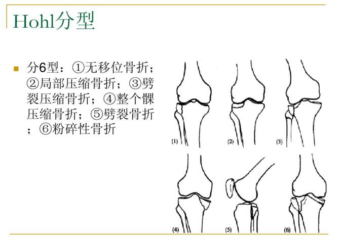 結節骨折 3,交叉韌帶附麗點骨折a2——關節外骨折,幹骺端簡單骨折1