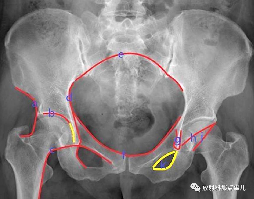 骨盆和髖關節的x線評估及測量大全