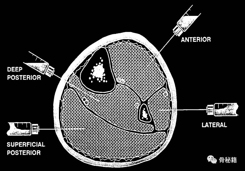 骨科医生必备技能——筋膜间室减压 好医术早读文章 好医术赋能医生守护生命