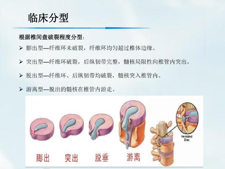 作者介绍:许树柴主任医师,医学博士省中医院二沙岛分院骨科主任,广州