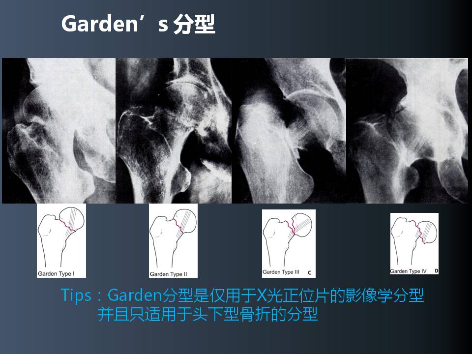 股骨頸骨折的優化固定