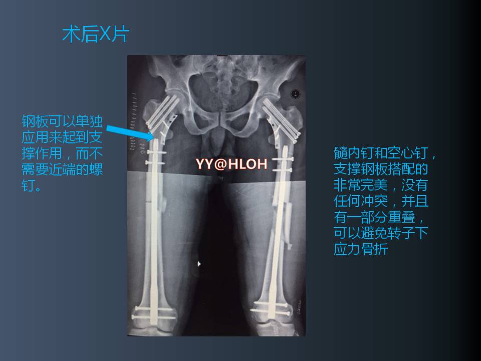 股骨頸骨折的優化固定