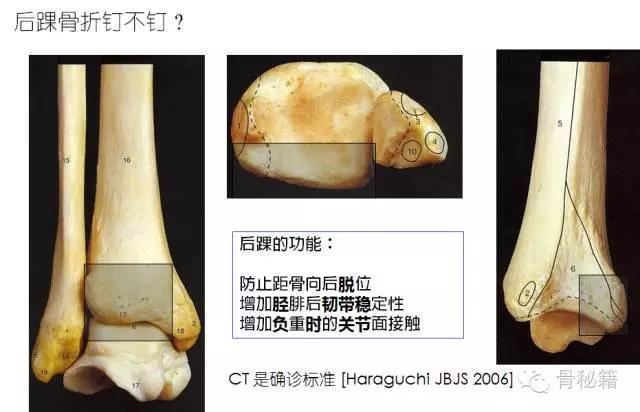 踝關節骨折的那些爭議