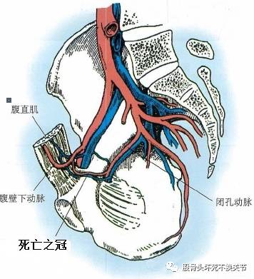 恥骨上支粉碎性骨折合併巨大血腫(死亡之冠損傷出血引起)由於副閉孔