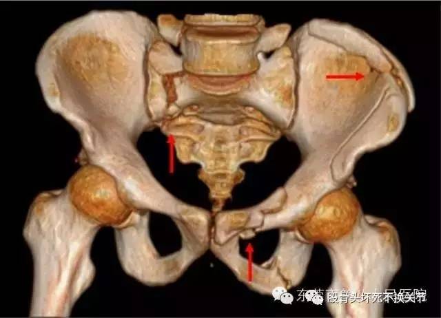 收藏| pao,骨盆骨折必知之