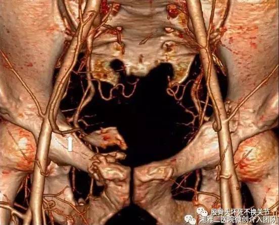 收藏| pao,骨盆骨折必知之"死亡冠" - 好医术早读