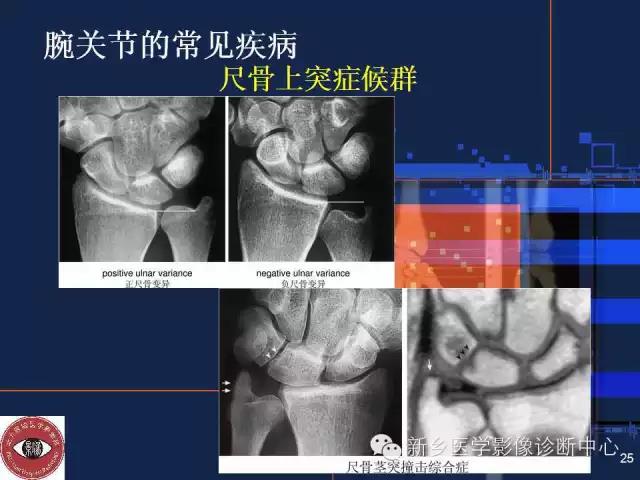 腕關節x線攝影基礎,讓疾病無處可逃!