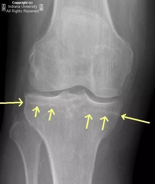 右膝关节病变,请诊断