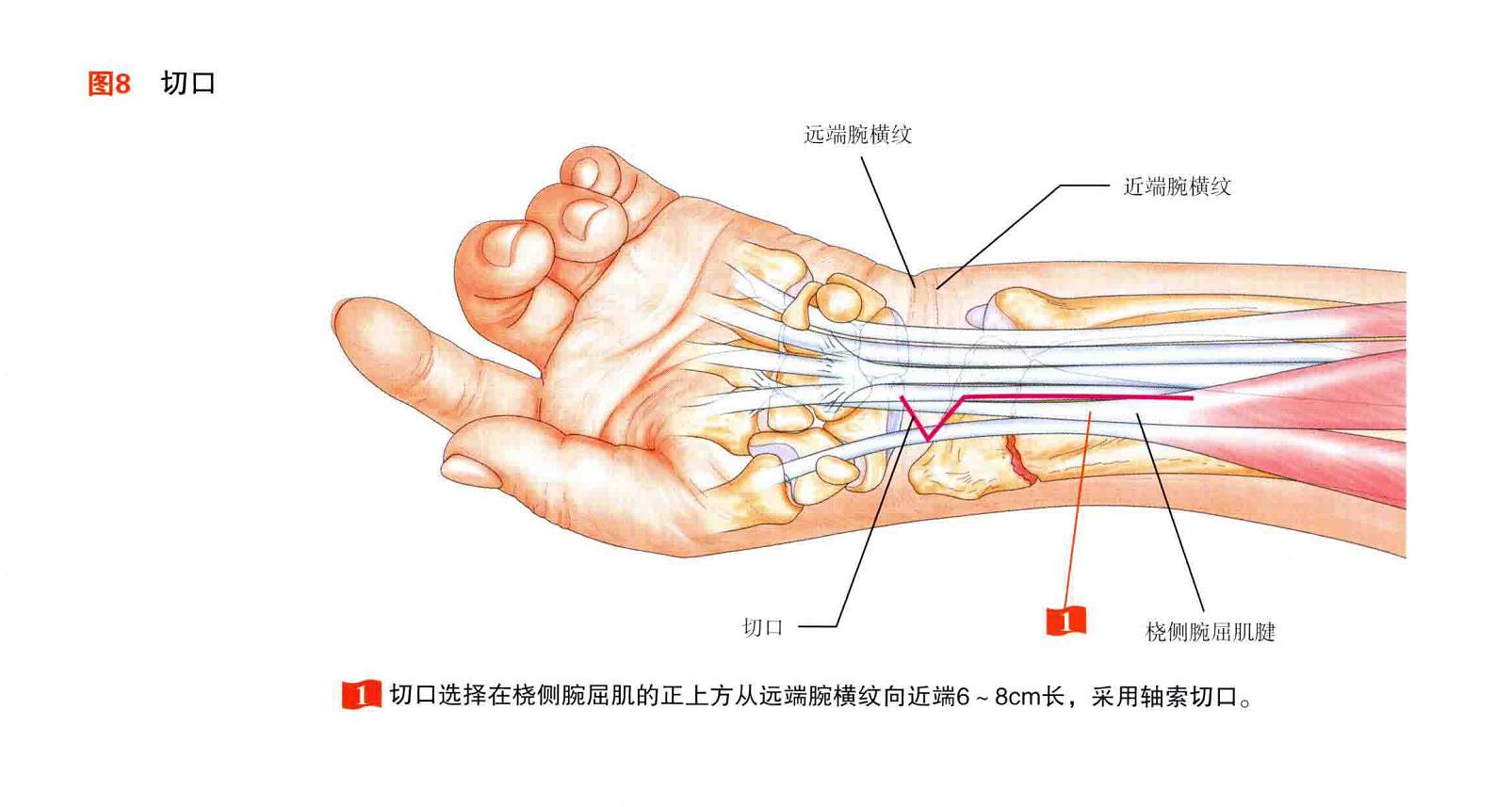 桡骨远端骨折钢板固定的手术技巧