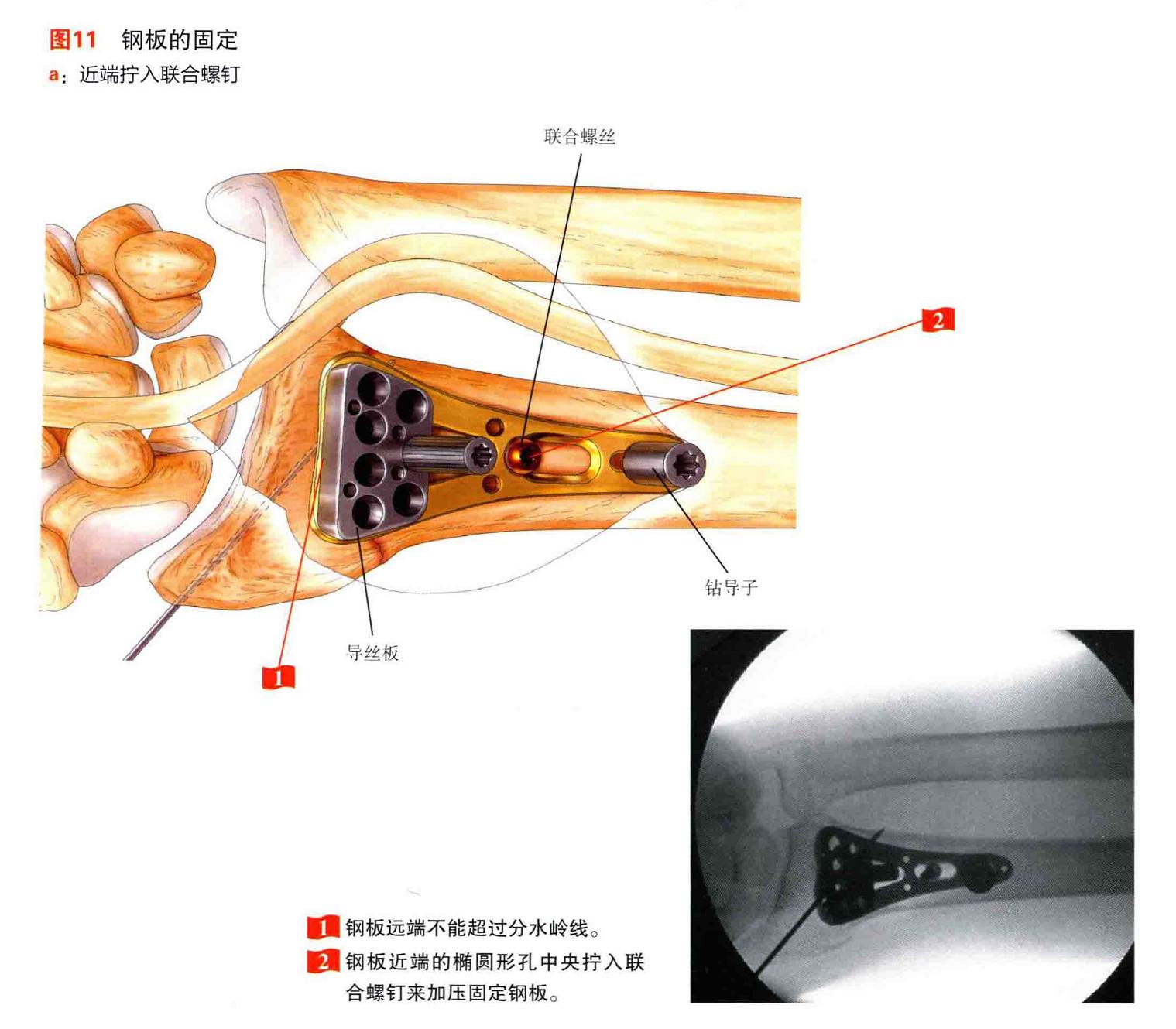 图3-117 尺桡骨下端、腕骨和掌骨(后面观)-外科学-医学