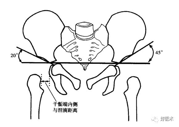 perkin方格连接两侧髋臼"y"形软骨作一水平线,再自髋臼顶外缘作一垂线