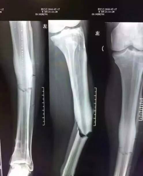 登巴巴断腿伤情牵动人心胫腓骨骨折应如何治疗 好医术早读文章 好医术 赋能医生守护生命