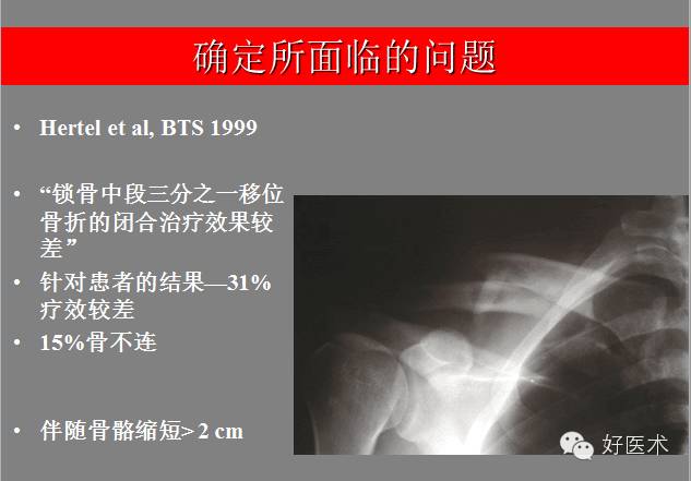 锁骨骨折移位,加拿大医生360度全解析 - 好医术早读文章 - 好医术-赋能医生守护生命