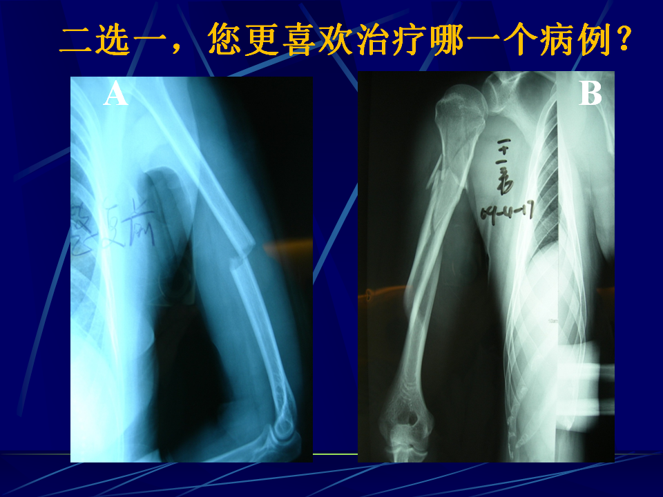 肱骨幹骨折保守治療的技巧與陷阱