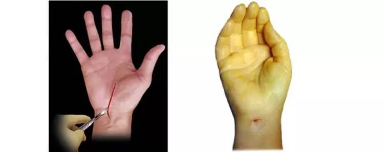 内窥镜下手术需要昂贵的器械吗?